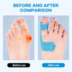 🦶 Bunion Correction Patches: Hospital-recommended—resolve your toe issues completely in just one week, with no recurrence for life!